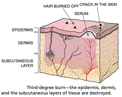 اضغط على الصورة لعرض أكبر

الاسم: Third-degree-burn-2.jpg?resize=500%2C401&amp;ssl=1.jpg
الحجم: 50.2 كيلوبايت
رقم التعريف: 226671