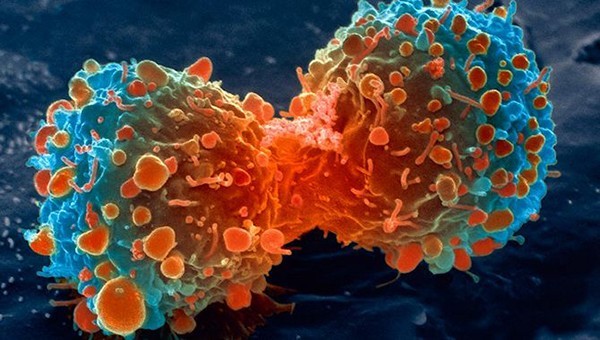 lung-cancer-cell-dividing-article.__v80030169 أهم أسباب الإصابة بمرض السرطان وطرق الوقاية منه