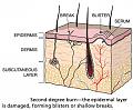 اضغط على الصورة لعرض أكبر

الاسم: Second-degree-burn-1.jpg?resize=500%2C412&amp;amp;ssl=1.jpg
الحجم: 60.0 كيلوبايت
رقم التعريف: 226668