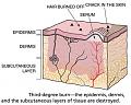 اضغط على الصورة لعرض أكبر

الاسم: Third-degree-burn-2.jpg?resize=500%2C401&amp;amp;ssl=1.jpg
الحجم: 50.2 كيلوبايت
رقم التعريف: 226670